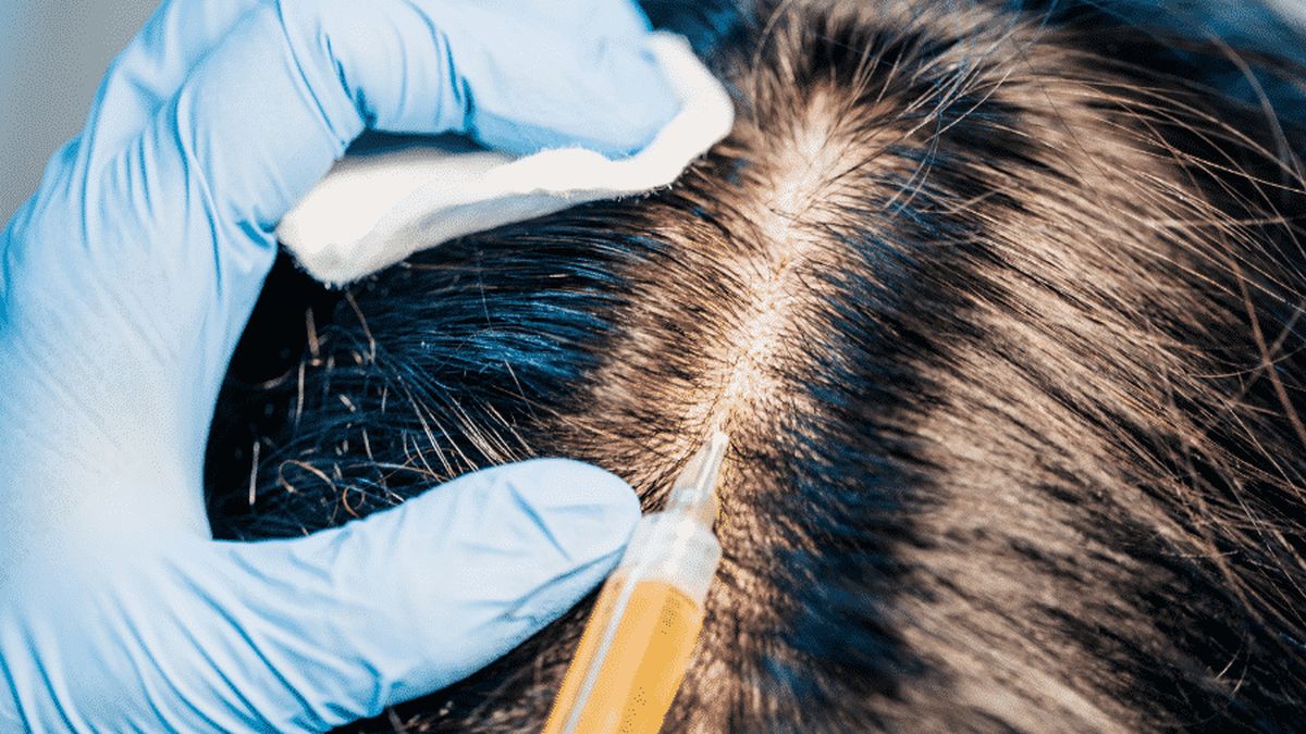Hair transplant: the advantages and disadvantages, Before After