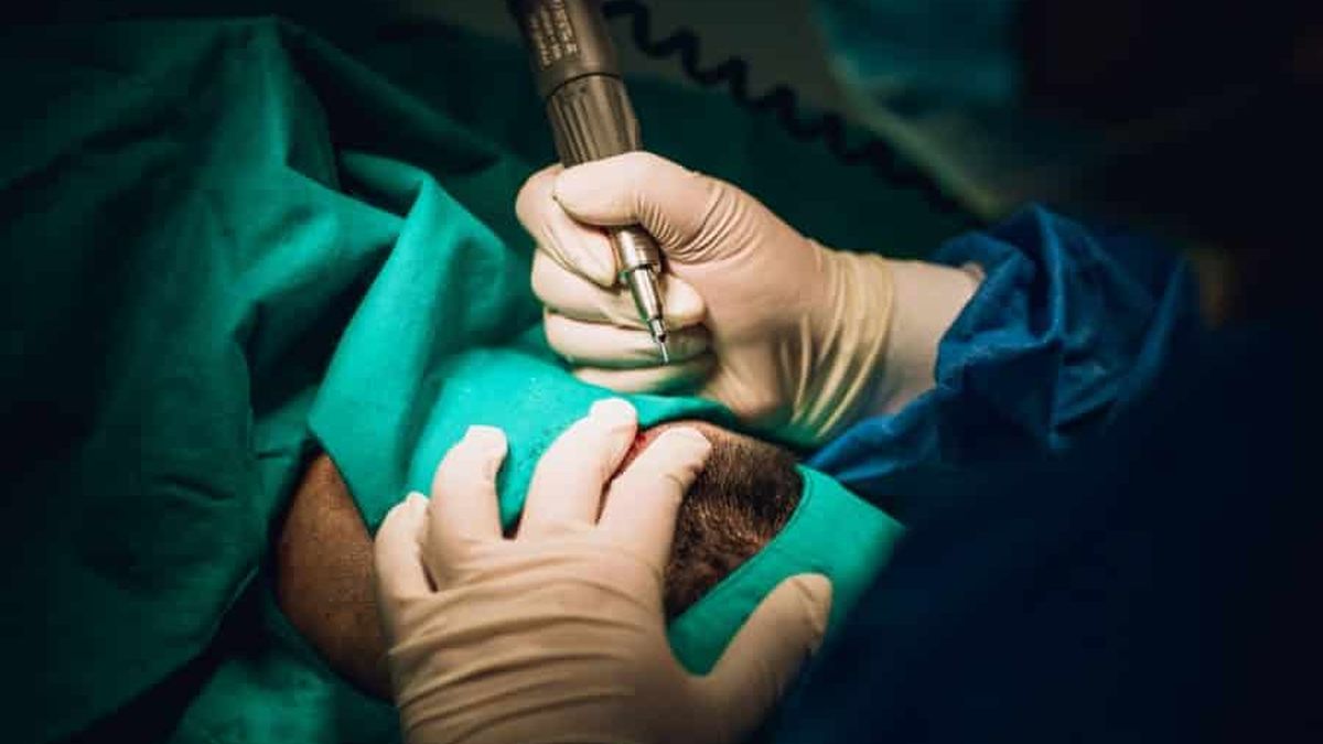 Implant capillaire : tout ce qu'il faut savoir