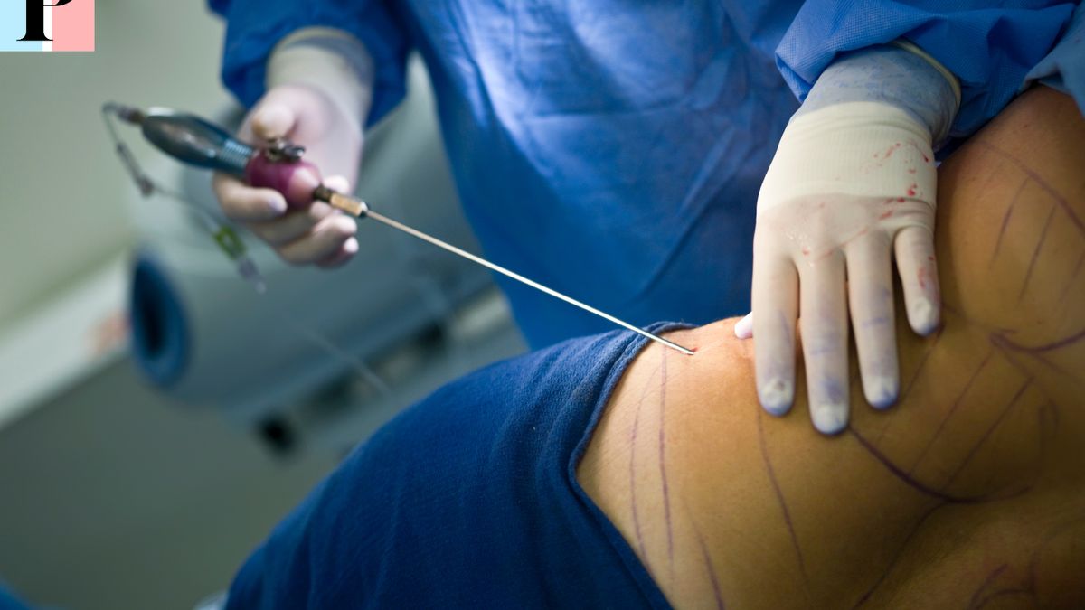Liposuccion : Prix, tarifs et procédure pour retrouver une silhouette harmonieuse