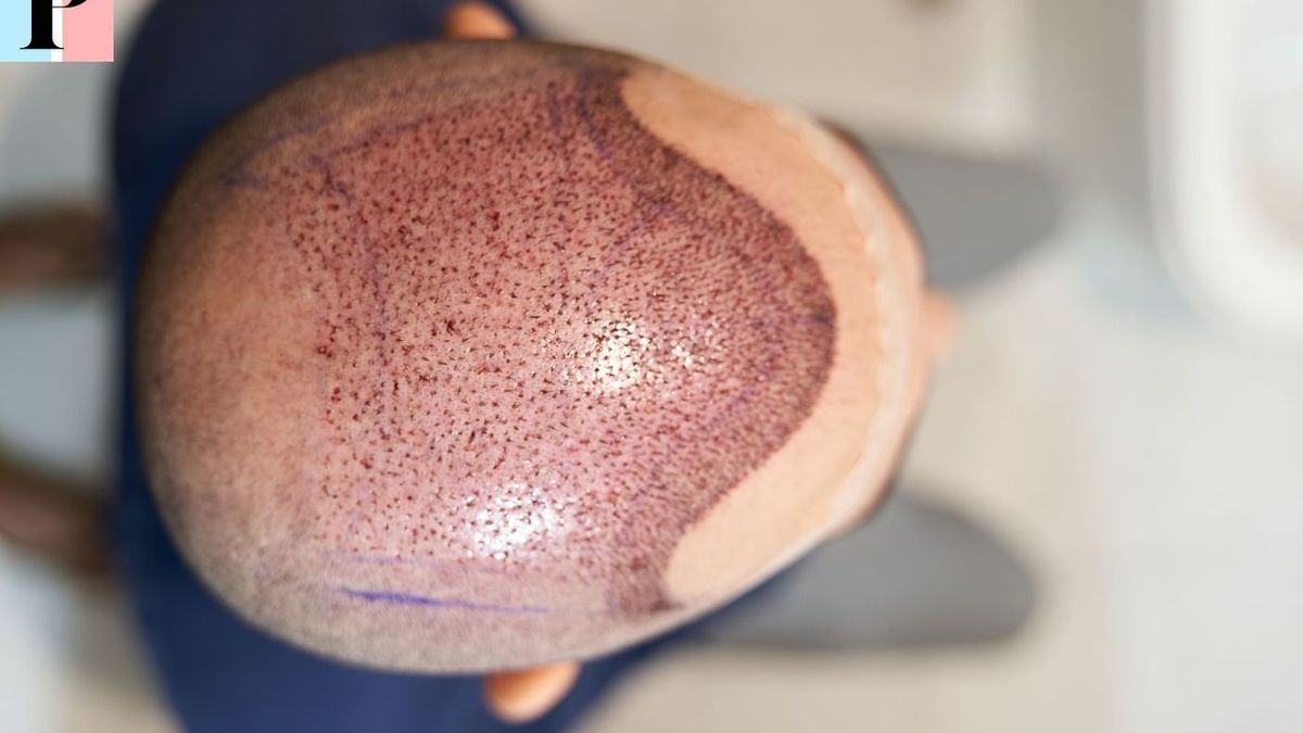 Greffe de cheveux Turquie : FUE, FUT, DHI, quel technique pour votre implant capillaire ?
