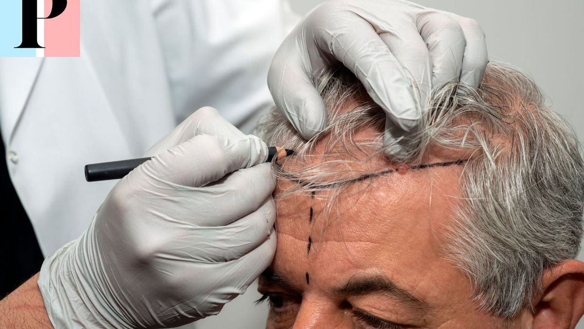 L'art de la greffe de cheveux : tout savoir sur cette intervention capillaire