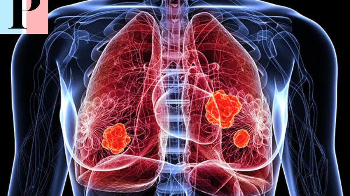 Cancer : les habitudes quotidiennes qui augmentent (ou réduisent) vos risques